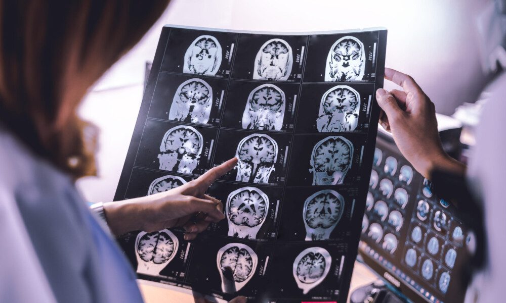 At Bell Law Firm, we understand the complexities of stroke misdiagnosis cases. Here's how to spot and prevent potential stroke misdiagnosis.